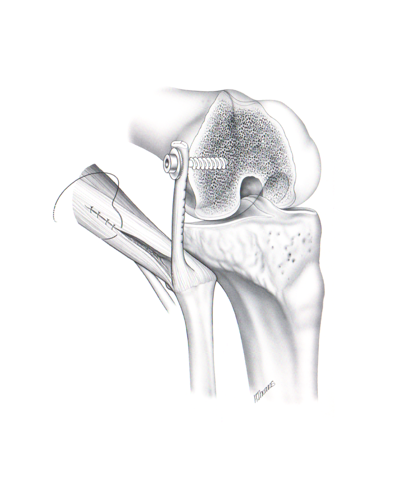 reconstructionofthelateralcollateralligament Kniecentrum